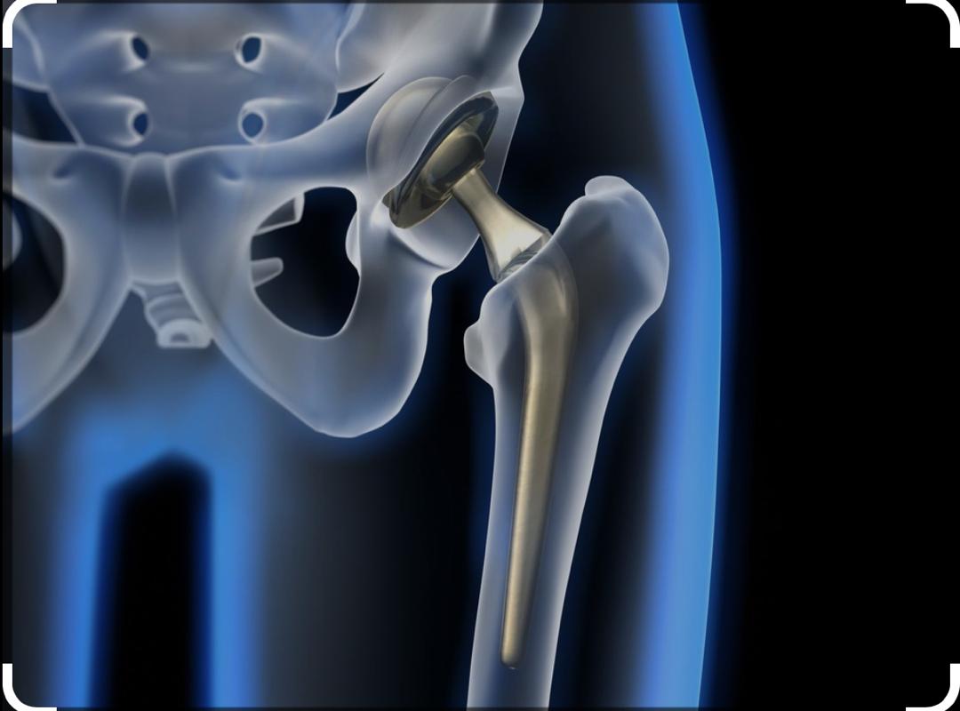 Arthroplastie totale de hanche